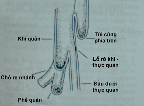 Rò thực quản và khí quản: Những điều cần biết