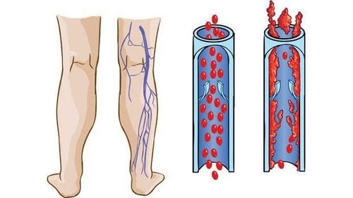 
Bệnh nhân bị huyết khối tĩnh mạch sâu ở chi dưới
