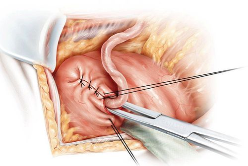 Endoscopic re-implantation of 2 ureters to treat congenital vesicoureteral reflux