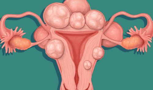 U xơ tử cung dưới thanh mạc có ảnh hưởng đến thai kỳ?