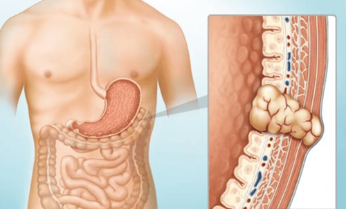 Gastrointestinal stromal tumor