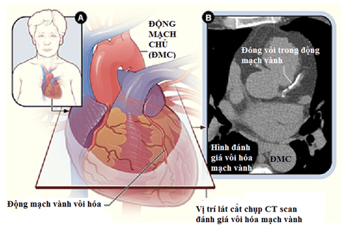 
Quét canxi vành giúp phát hiện bệnh lý mạch vành
