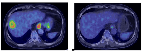 
So sánh hình ảnh PET- CT trước và sau điều trị cho thấy: Khối u thực quản, hạch cạnh dạ dày, tổn thương di căn gan giảm nhiều về số lượng, kích thước và chuyển hóa FDG
