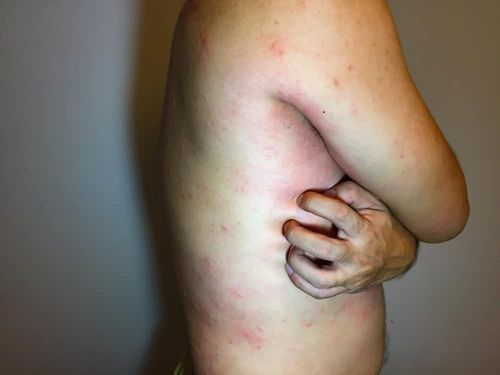 Is lupus erythematosus contagious?