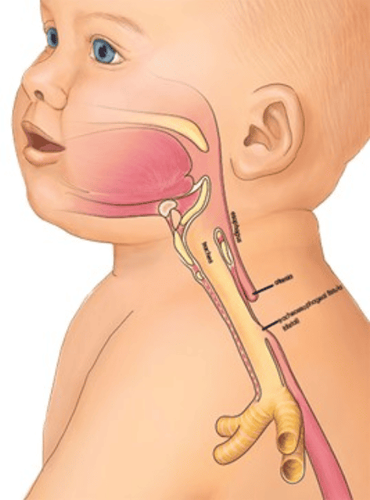 
Teo thực quản bẩm sinh khiến trẻ không thể nhận đủ dinh dưỡng bằng đường miệng
