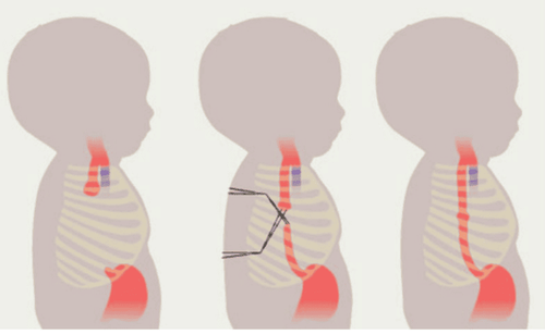 Surgery to treat atrophy of the esophagus