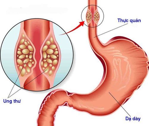 
Ung thư thực quản được chỉ định thuốc cản quang đường uống
