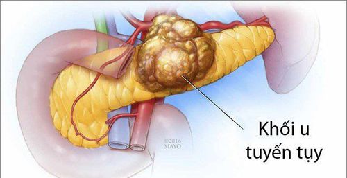 
Ung thư tuyến tụy
