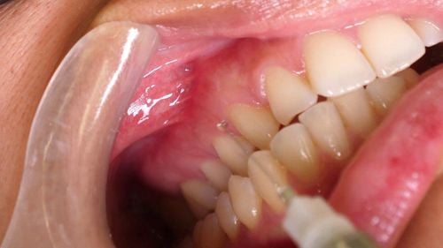 Local anesthetic method for tooth extraction