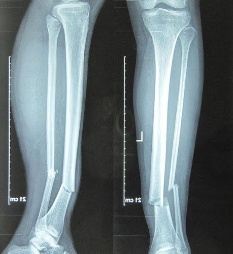 X-ray procedure of straight shin bone