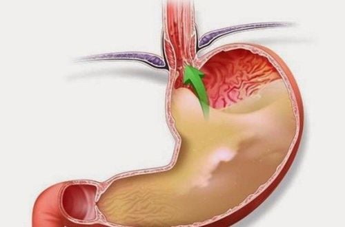 
Lượng acid trong dịch vị dạ dày có thể bị thừa trào lên thực quản
