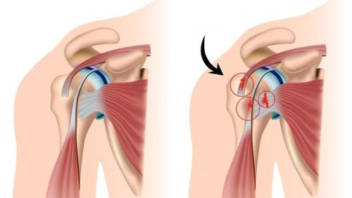 Laparoscopic surgery of rotator cuff sutures