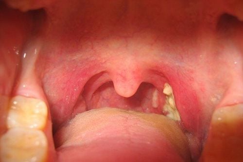 
The most common bacterial strain that causes tonsillitis at the base of the tongue is group A streptococcus
