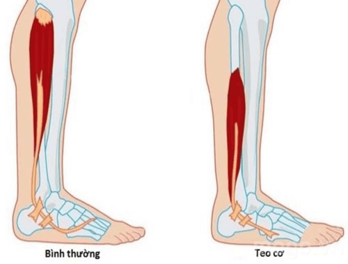 
Teo cơ có thể là triệu chứng của hội chứng đau cục bộ phức hợp
