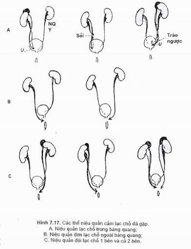 
Một số dạng niệu quản lạc chỗ
