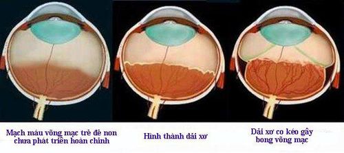 
Một số giai đoạn của bệnh lý võng mạc sinh non
