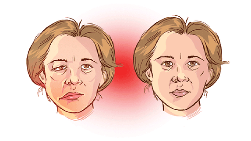 Complications of myasthenia gravis