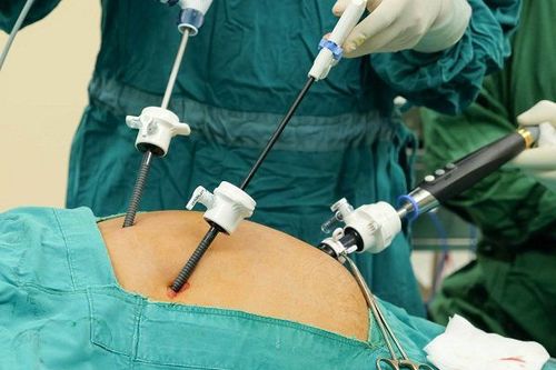 How is laparoscopic appendectomy (1 hole) performed?