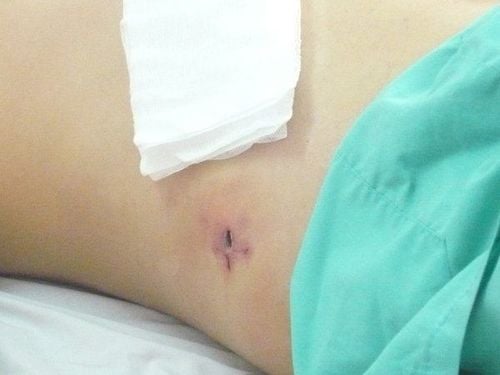 4 days after appendectomy, the incision is slightly itchy, is it infected?