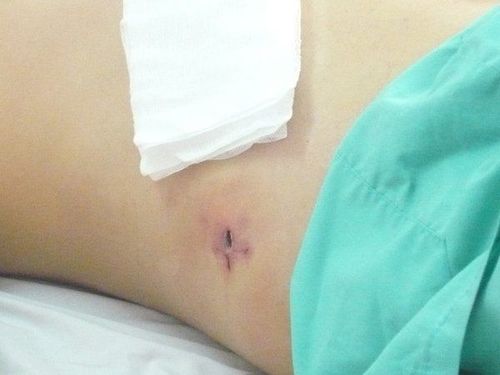 Is early drainage after appendectomy dangerous?