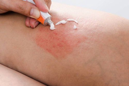 What is the difference between Psoriasis and Eczema?