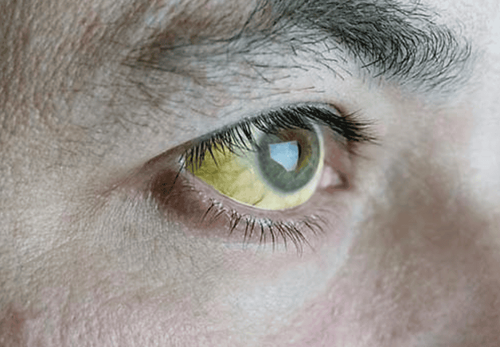 Vàng mắt và tụt huyết áp có phải là triệu chứng của các bệnh về gan?