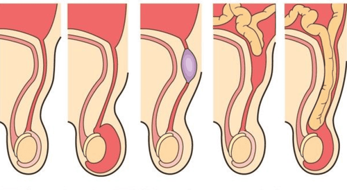 Learn about peritoneal tube disease in children