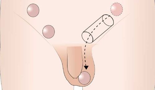 Laparoscopic surgery to lower the undescended testicle