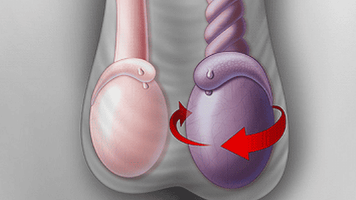 
Tinh hoàn ẩn có thể gây ra biến chứng xoắn tinh hoàn
