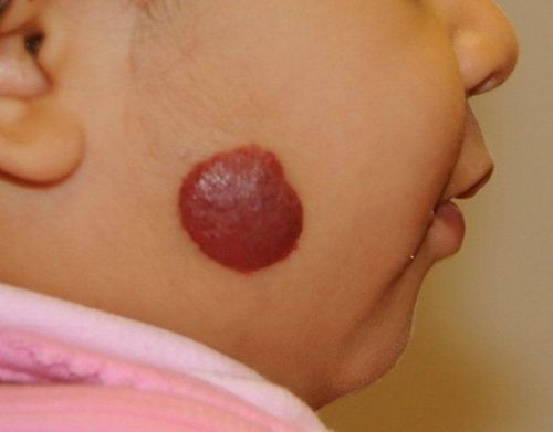 Surgery to remove large hemangiomas and what you need to know