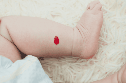 Small hemangioma surgery and what you need to know