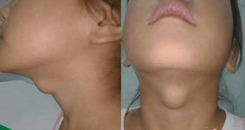 Diagnosis and treatment of thyroid cysts