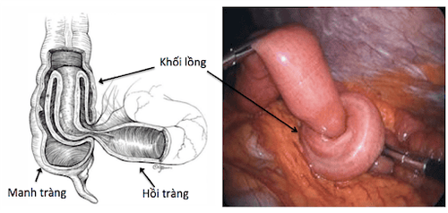 
Tháo lồng ruột bằng phẫu thuật
