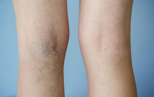 Venous sclerotherapy for varicose veins