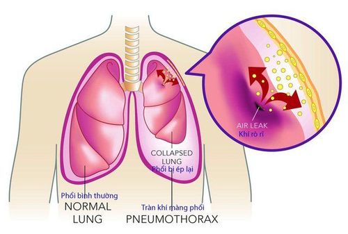 Vì sao có tình trạng tràn khí màng phổi tự phát?
