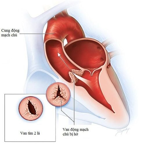 
Van tim bị vôi hóa
