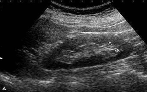 How is the ultrasound image to diagnose spongiform kidney disease?