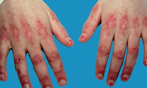 Dermatomyositis: Diagnosis, treatment