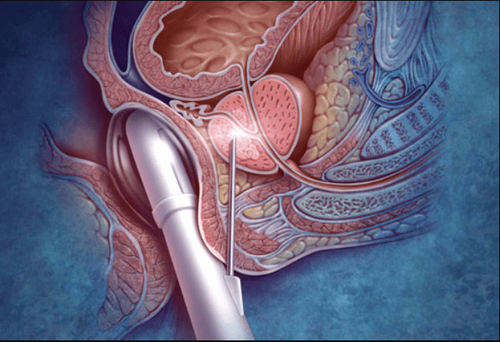 Preparing and performing transrectal ultrasound