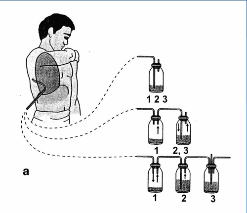 
Hệ thống dẫn lưu màng phổi một chiều
