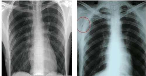 What diseases do X-rays of pneumonia detect?