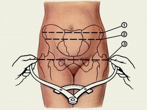 Bất tương xứng đầu chậu gây khó sinh
