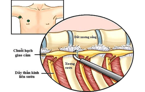 
Cắt hạch giao cảm điều trị chứng tăng tiết mồ hôi
