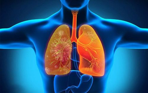 Các biện pháp phòng ngừa viêm phổi ở người lớn