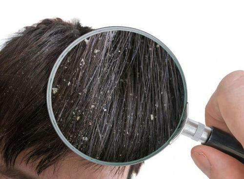 What you need to know about dandruff