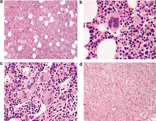 
Đa hồng cầu nguyên phát (polycythemia vera – PV)
