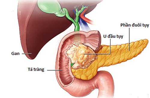 
Hầu hết các bệnh nhân mắc xơ nang đều dẫn đến suy tuyến tụy
