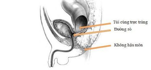 Dị tật hậu môn trực tràng ở trẻ sơ sinh