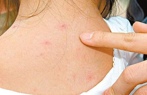 Should I take a bath if I have chickenpox with a low fever?