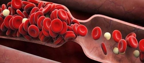 Dấu hiệu tắc mạch máu là gì?